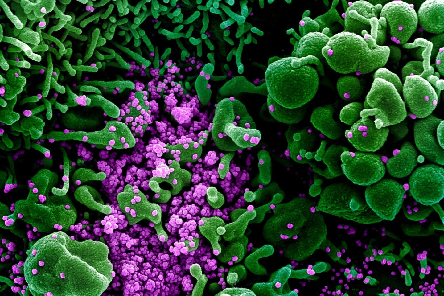 Eine Zelle (grün) ist mit dem Coronavirus (SARS-CoV-2, violett) infiziert. Die Probe wurde von einem Patienten in den USA isoliert.