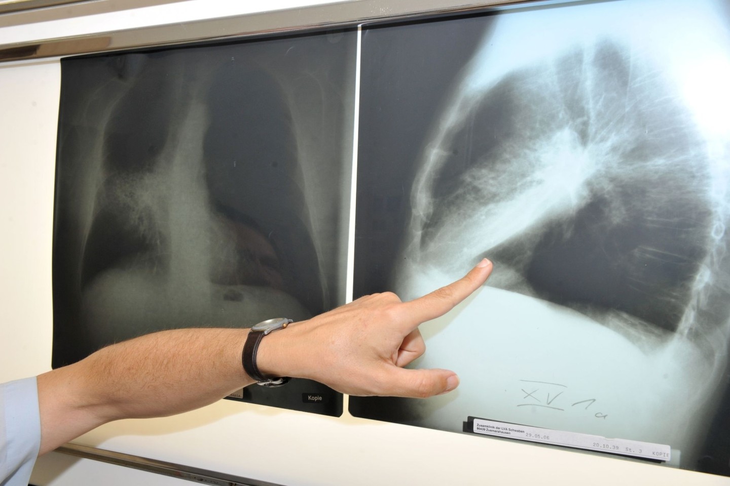 Der Leiter der Pneumologie (Lungenheilkunde) im Klinikum der Universität München zeigt auf ein Röntgenbild einer von Krebs befallenen Lunge.